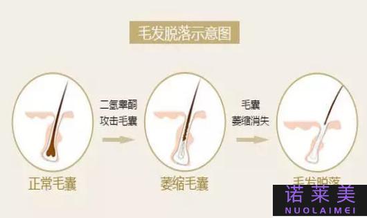 脱发属于哪个科室