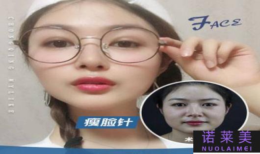 瘦脸针进口牌子哪个好