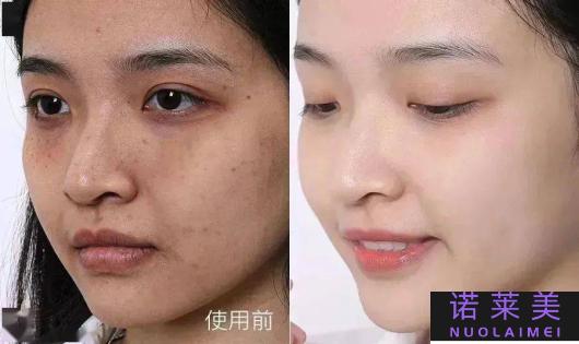 有斑的用后哪个系列最好